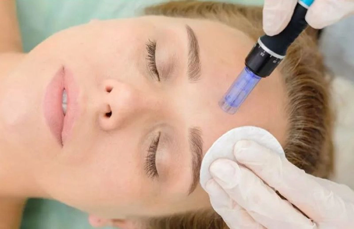 میکرونیدلینگ یکی از انواع روش های جوانسازی پوست