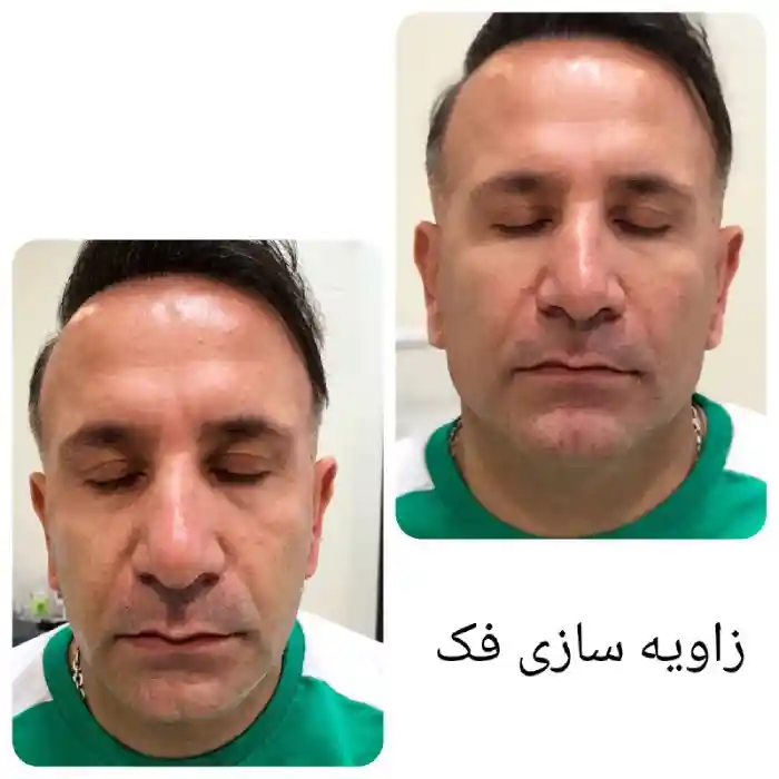 چه زمانی باید برای جوانسازی پوست اقدام کنیم؟