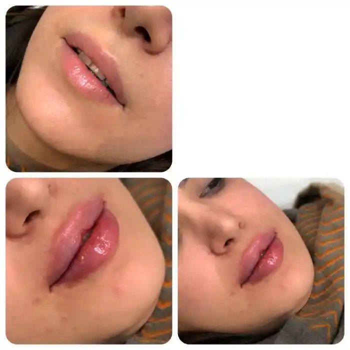 تزریق ژل به چه صورت است
