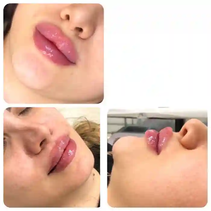 دوره نقاهت در تزریق ژل لب چاکدار چیست