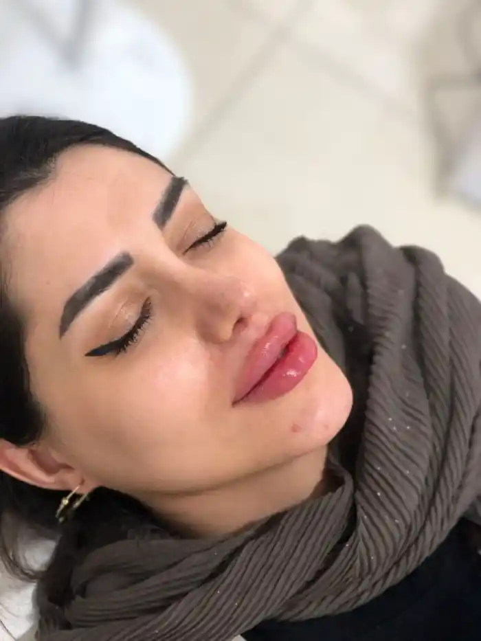 عوارض تزریق ژل لب