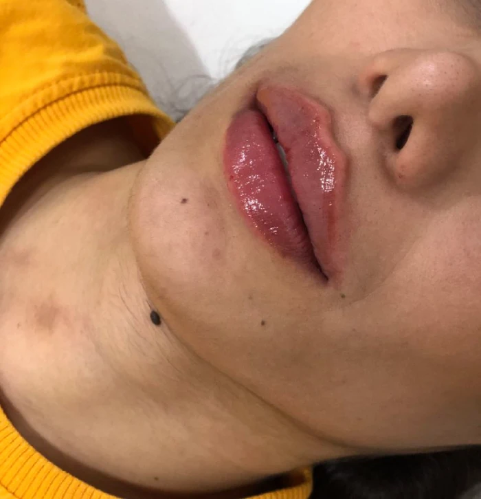 قیمت تزریق ژل لب کرج