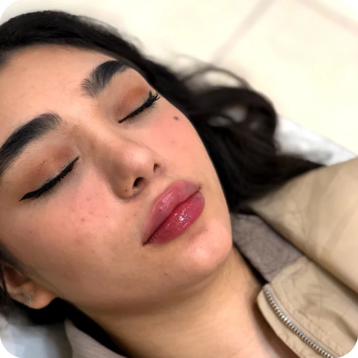 مراقبت های بعد از تزریق ژل لب 