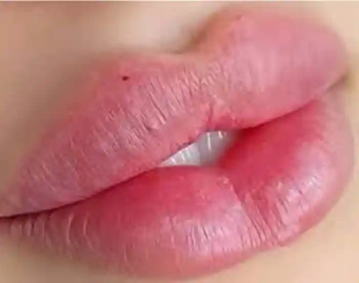 نکات مهم انتخاب برند ژل لب برای تزریق ژل مدل لب چاکدار