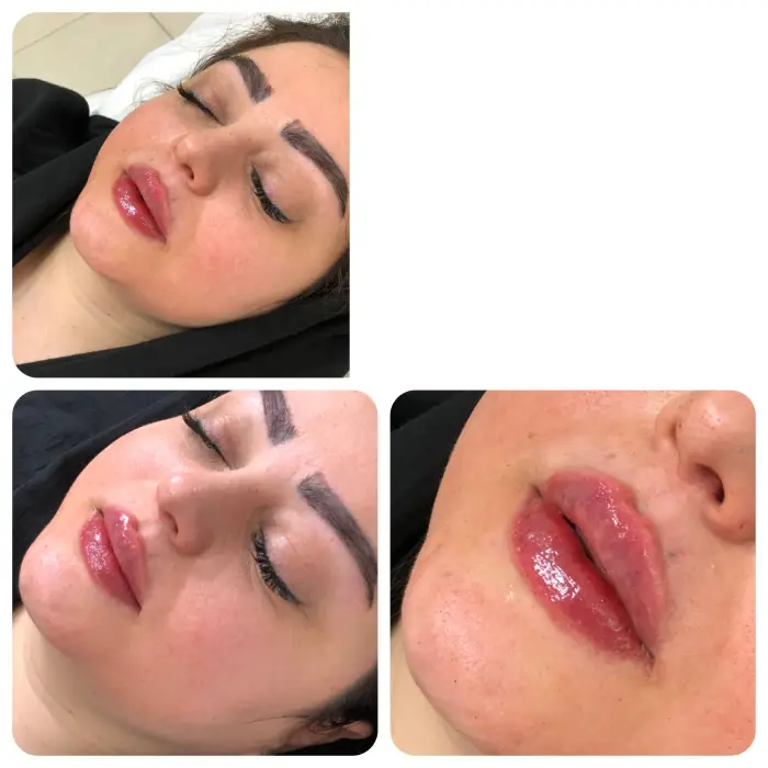 ویژگی های بهترین برند تزریق ژل لب کرج