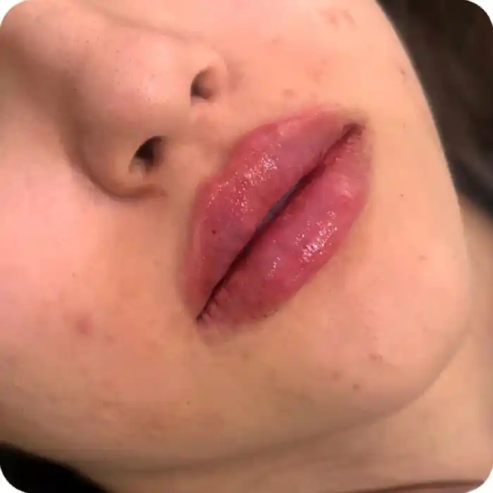 انواع مدل تزریق ژل لب کرج
