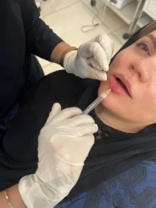 ژل لب چاکدار چیست