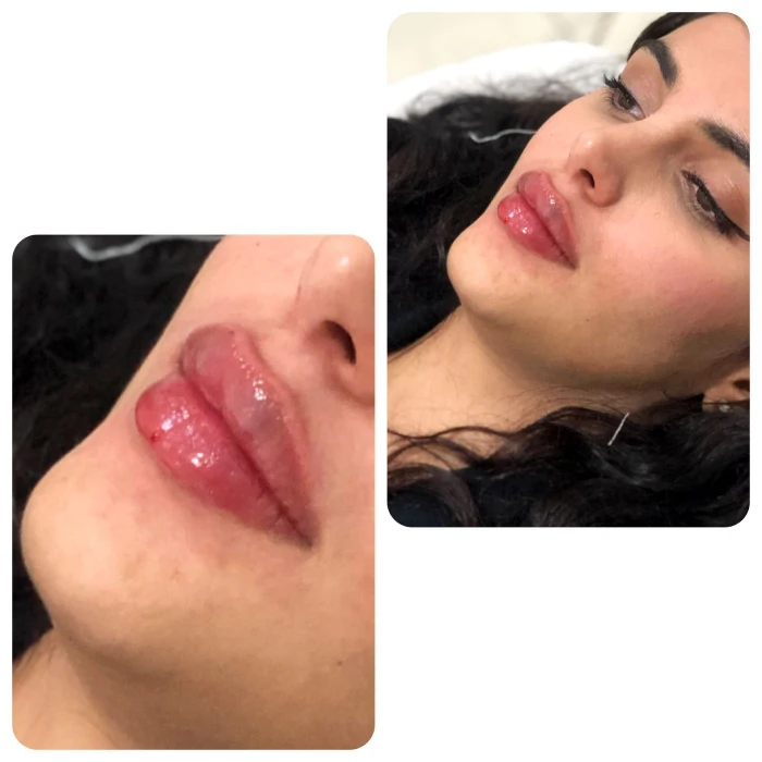 نکات مهم برای انتخاب بهترین ژل برای تزریق ژل لب ارزان در کرج