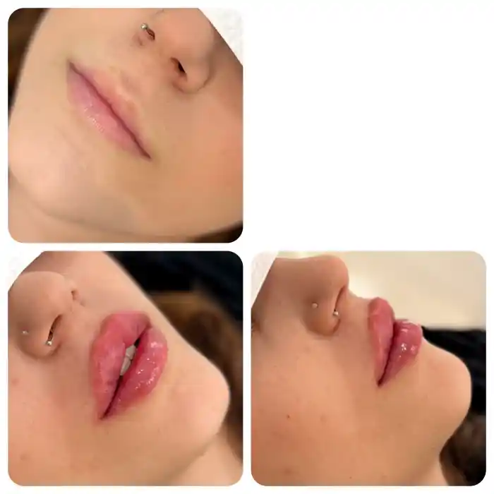 برای ژل لب روسی از چه ژلی استفاده می شود