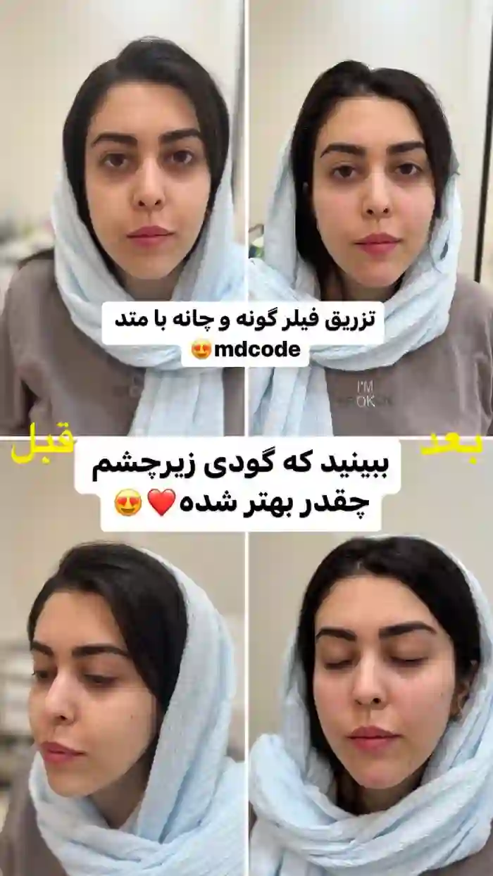 بهترین برند های تزریق ژل گونه