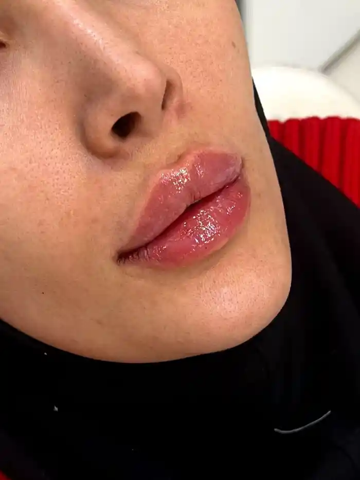 تجربه تزریق ژل لب در کرج از نگاه کاربران