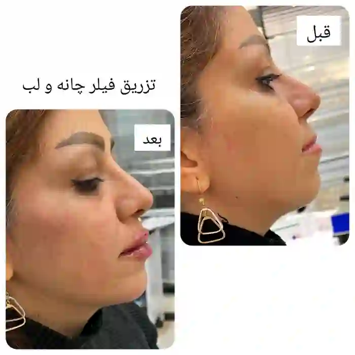 ترکیبات فیلرهای مخصوص تزریق ژل در چانه
