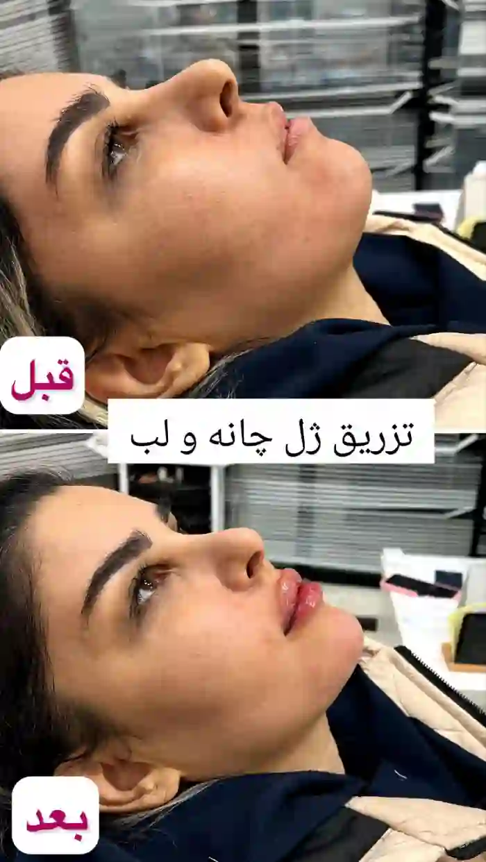 تزریق ژل در چانه+قیمت و عوامل موثر بر هزینه تزریق ژل و فیلر