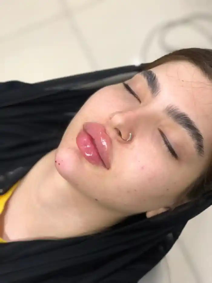 تزریق ژل لب روسی
