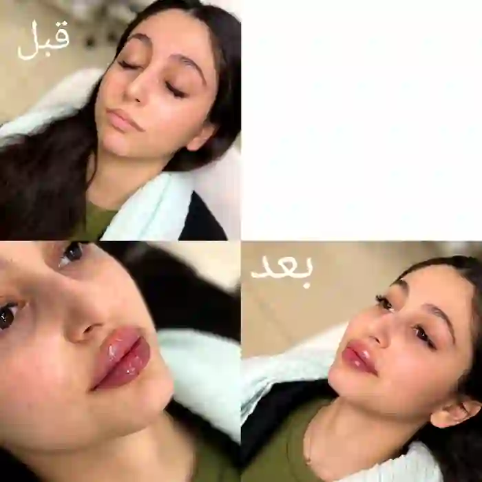تزریق ژل و فیلر