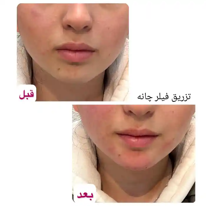 تزریق ژل چانه