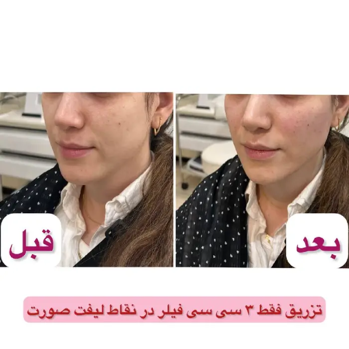 تزریق ژل گونه طبیعی