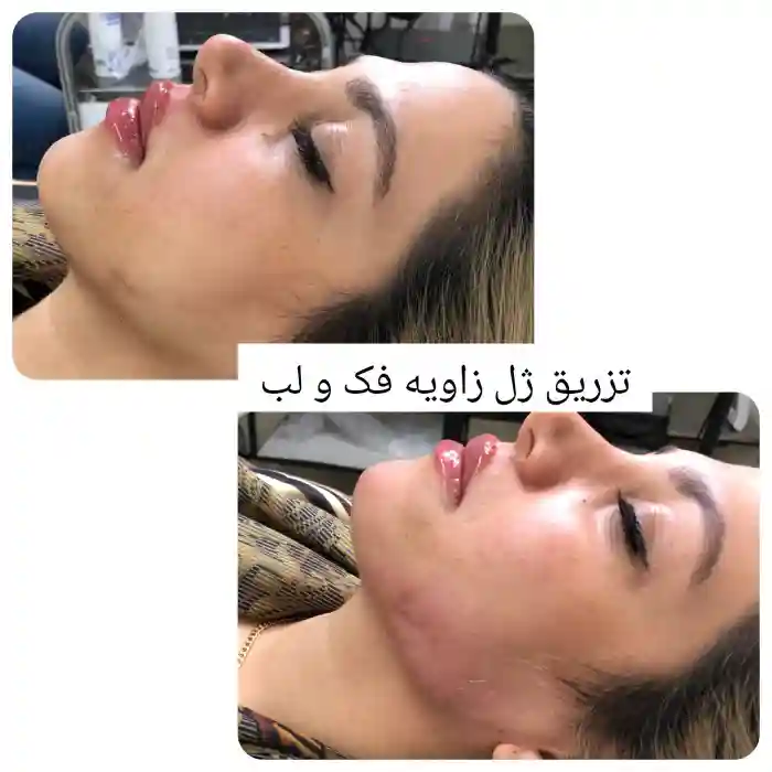 تزریق ژل گونه و تزریق ژل برای صورت لاغر و کشیده