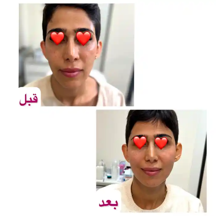 تزریق ژل گونه