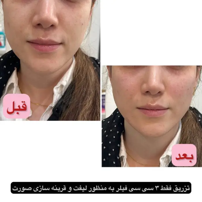دکتر تزریق ژل گونه طبیعی در کرج