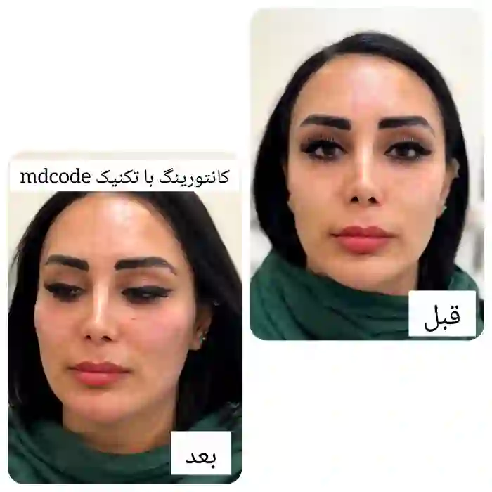 علائم هشداردهنده پس از تزریق ژل و فیلر