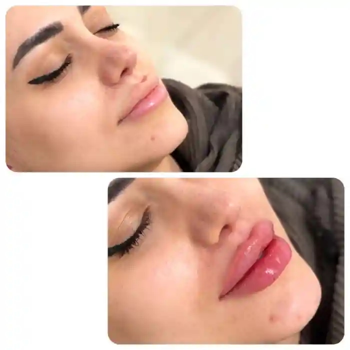 عوارض تزریق ژل لب در دوران شیردهی