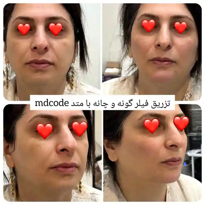 عوارض تزریق ژل گونه