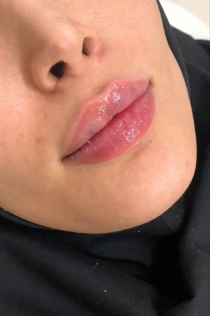 عوارض شایع تزریق ژل لب روسی