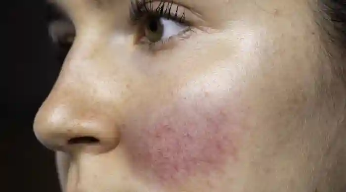 عوارض وحشتناک تزریق ژل به صورت