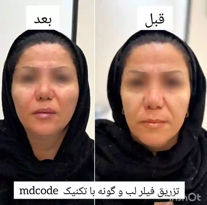 عوامل موثر بر قیمت تزریق ژل گونه