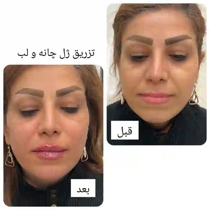 فواید کلی تزریق ژل و فیلر به نقاط مختلف صورت