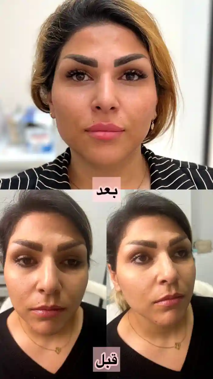 قیمت تزریق ژل صورت