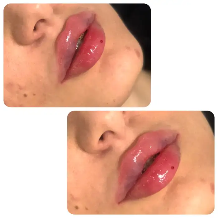 قیمت تزریق ژل لب چقدر است؟