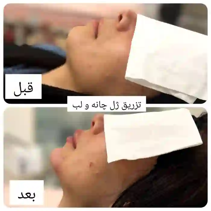 ماندگاری تزریق ژل چانه چقدر است؟