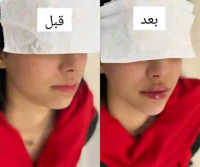 ماندگاری و نتایج نهایی تزریق ژل چانه