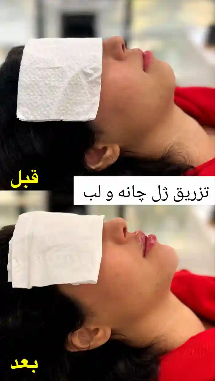 مراحل تزریق ژل لب