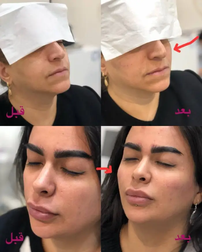 مزایای تزریق ژل گونه طبیعی در کرج