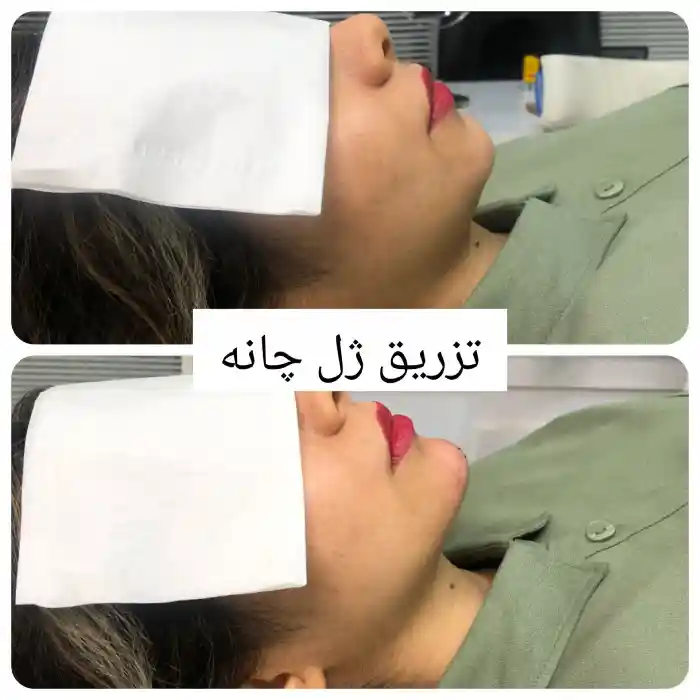 مزایای تزریق ژل گونه و چانه