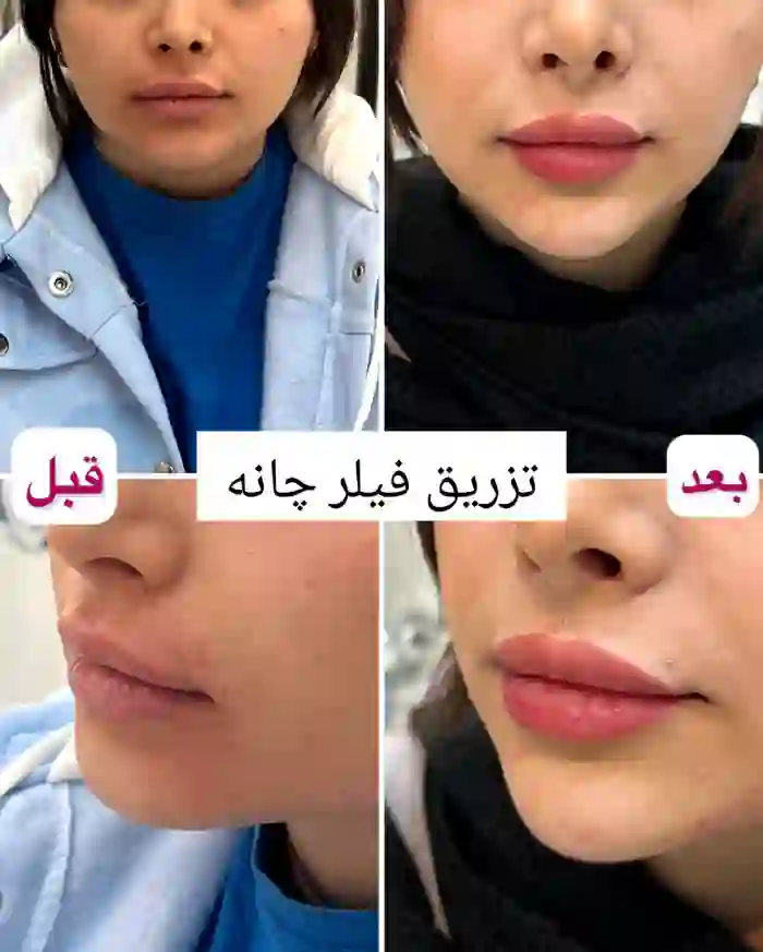 نواحی قابل تزریق فیلر در صورت هر فرد کدام اند