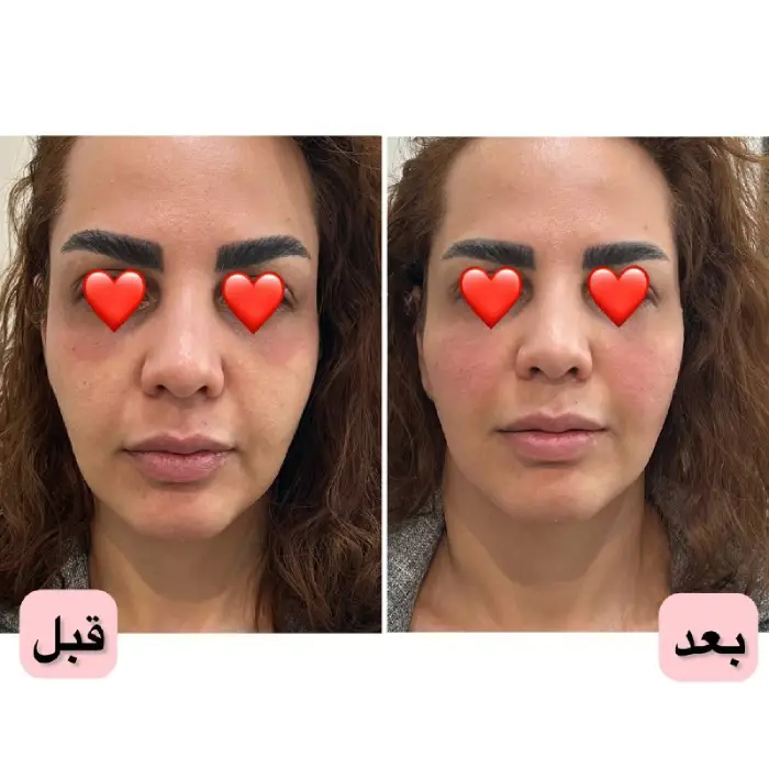 نکات مهم برای انتخاب دکتر تزریق ژل گونه طبیعی در کرج