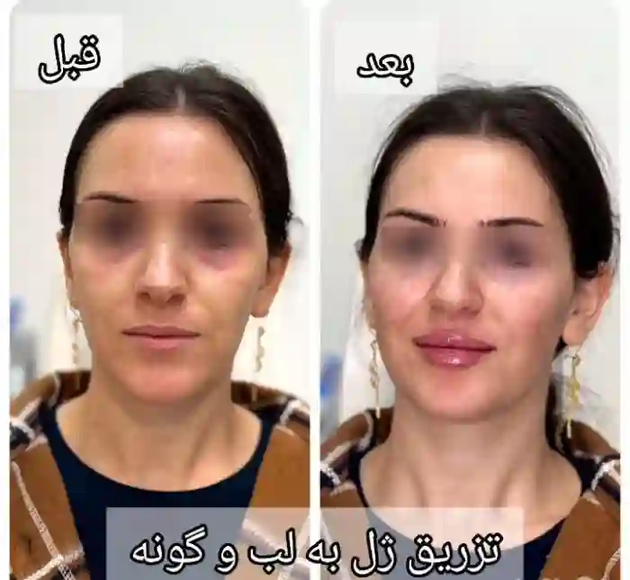 نکات مهم قبل از تزریق ژل گونه برای صورت کشیده