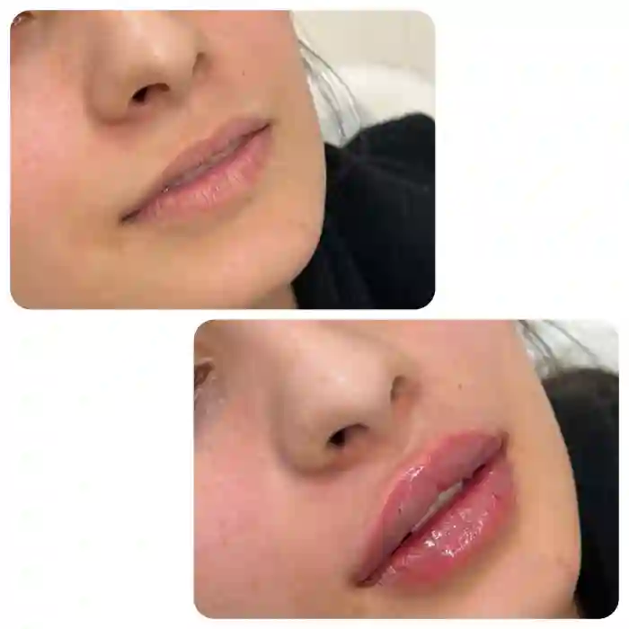 نکات مهم قبل از تزریق