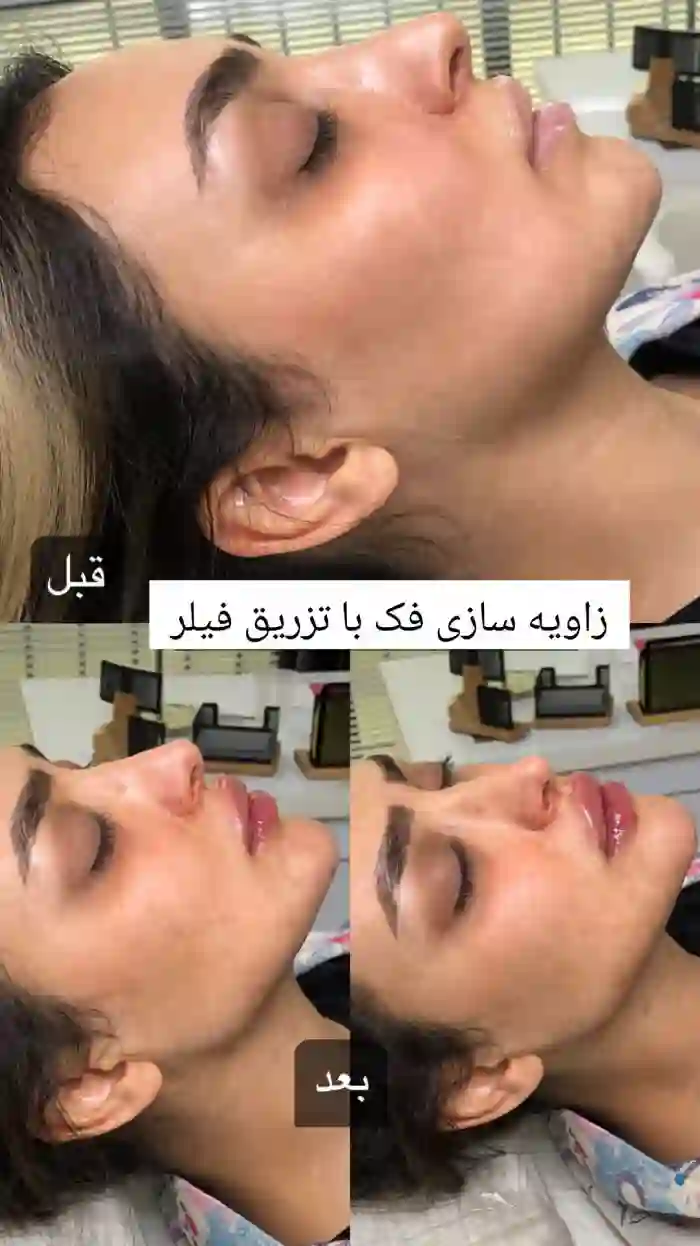 نکاتی که قبل از تزریق ژل باید بدانید