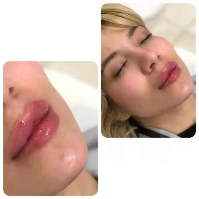 هر آنچه باید درباره تزریق ژل لب در حاملگی بدانید