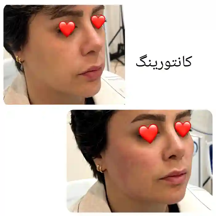 قیمت تزریق ژل گونه چقدر است و چه عواملی بر آن تاثیر میگذارد؟