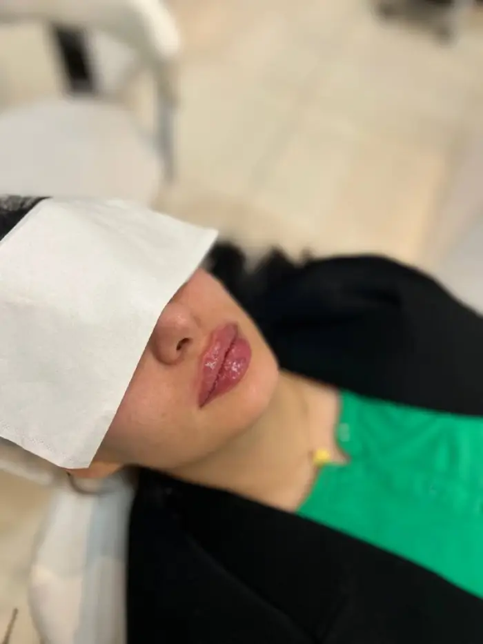 هزینه تزریق ژل لب دائمی کرج