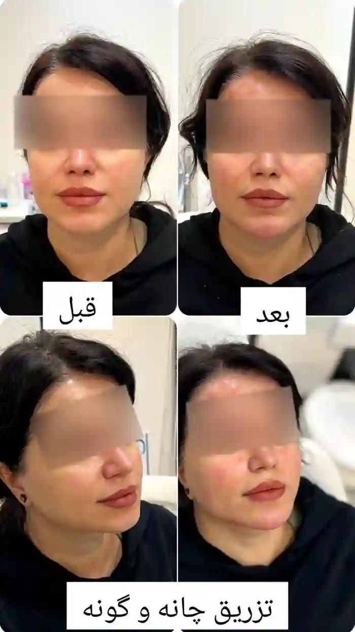 همه چیز درباره عوارض تزریق ژل به صورت