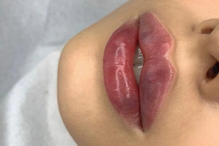 مزایای تزریق ژل لب در کرج