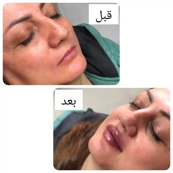کاربرد تزریق ژل لب روسی