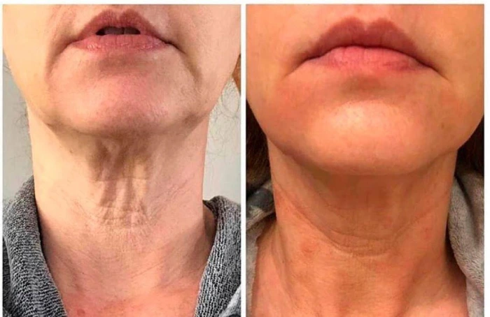 اندولیفت صورت در کرج